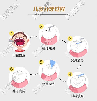 儿童补牙过程照片