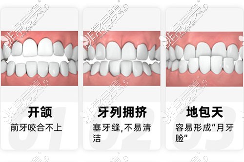 牙齒不齊情況示意圖