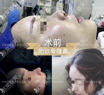 济南瑞丽医院隆鼻