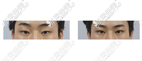 韩国真实整形外科双眼皮照片