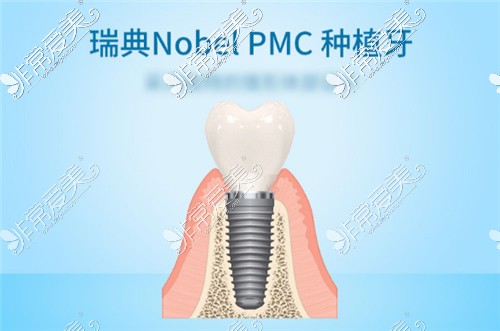 1Nobel PMC種植體