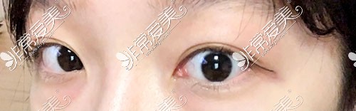 韩国Yellow整形外科双眼皮