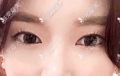 韩国Yellow整形外科双眼皮照片