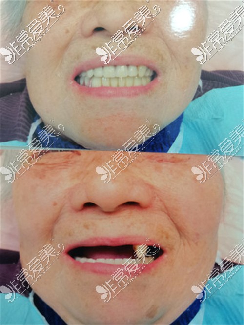 上海雅悦齿科治疗前后图