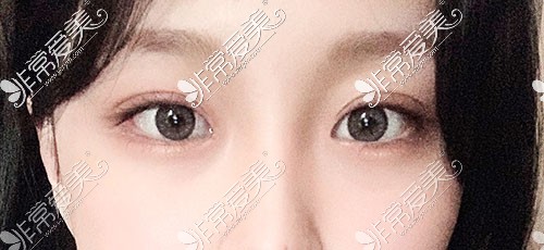 韩国Yellow整形外科双眼皮术后照