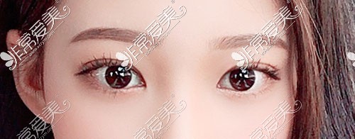 韩国Yellow整形外科双眼皮图片