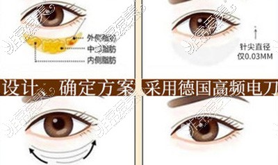 北京画美医疗美容祛眼袋方式