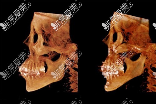 成都下颌角整形CT