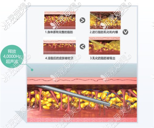 5G天使光雕吸脂原理图