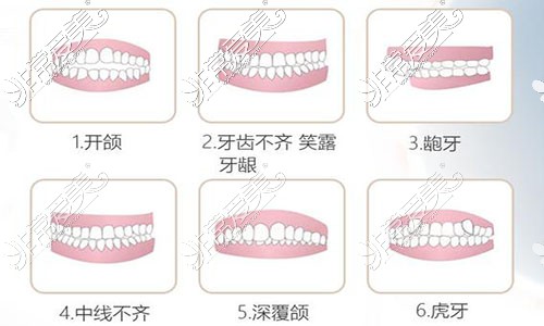 各种牙齿不齐情况