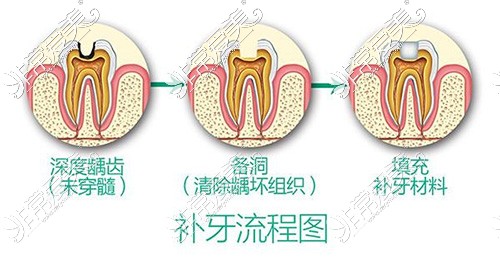 补牙流程展示图