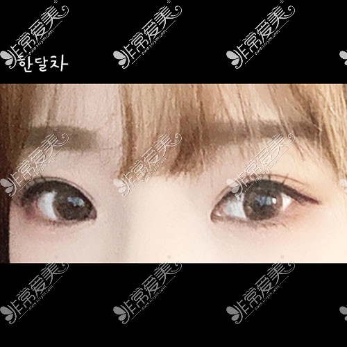 韩国icon整形双眼皮修复