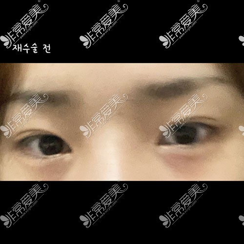 韩国icon整形双眼皮修复照片