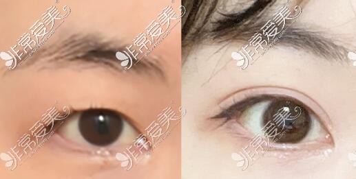 韩国icon整形医院双眼皮修复图