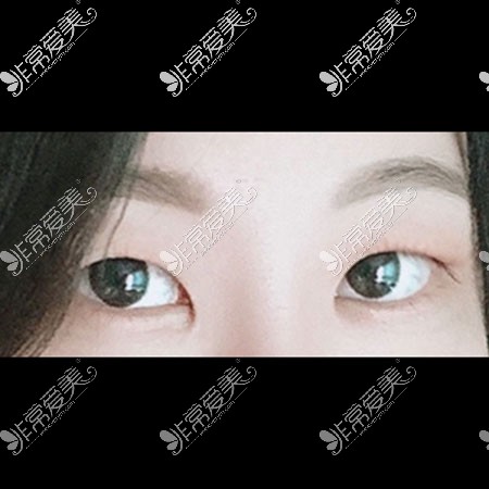 韩国icon整形医院双眼皮照片