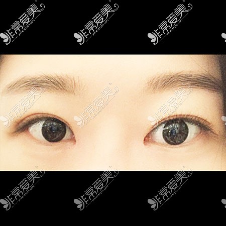 韩国icon整形医院双眼皮术后图