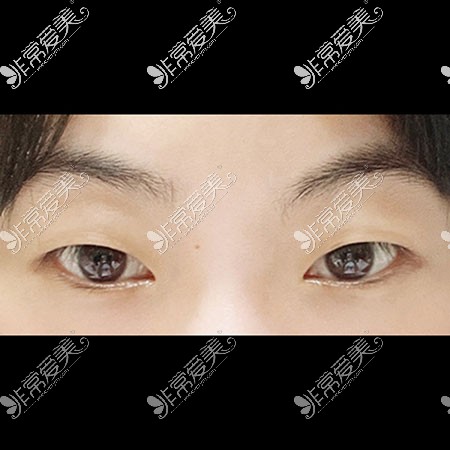 韩国icon双眼皮术前照片