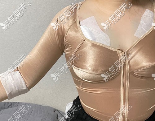 韩国芙莱思手臂吸脂穿塑身衣照片