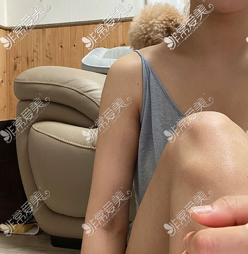 韩国snow手臂吸脂术后三个月