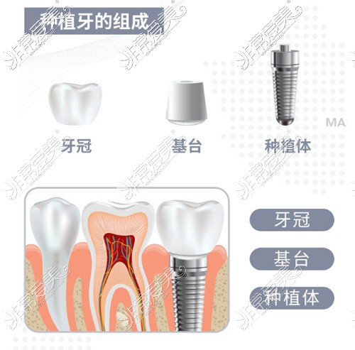 种植牙展示图