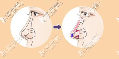 隆鼻示意图