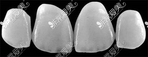 超薄牙齿瓷贴面