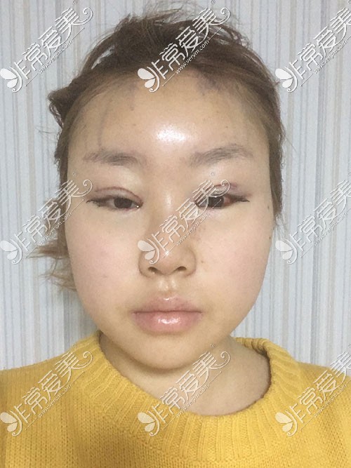 韩国tj整形双眼皮术后恢复图