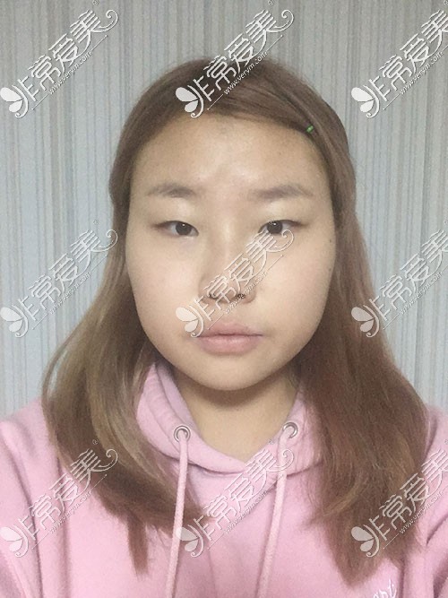 韩国tj整形双眼皮术前照片