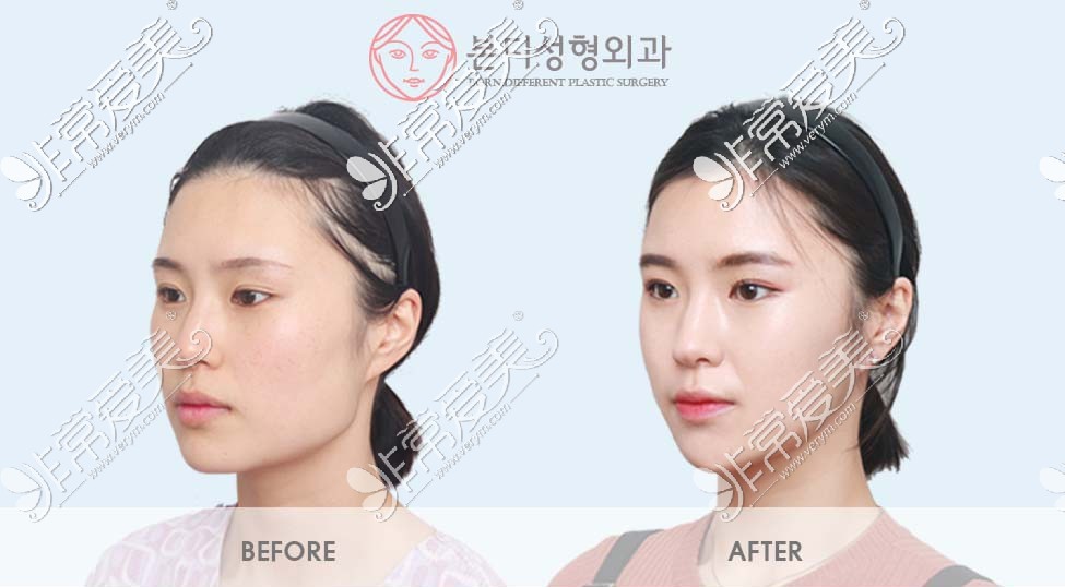 韩国BornDi整形下颌角手术图片