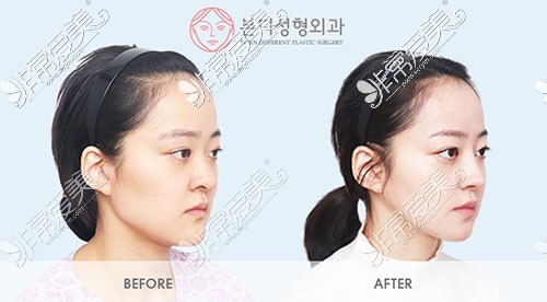 韩国BornDi整形下颌角手术对比图