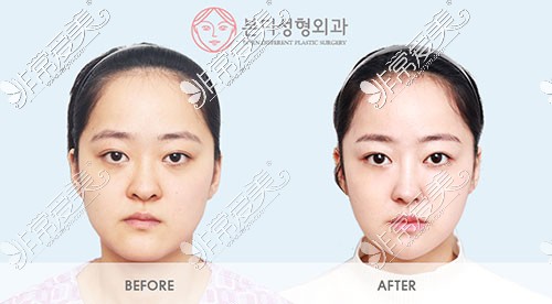 韩国BornDi整形轮廓手术对比图