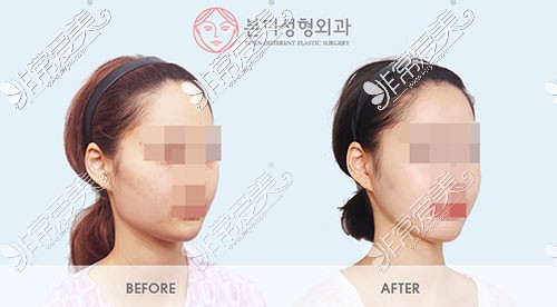 韩国BornDi下颌角手术图片