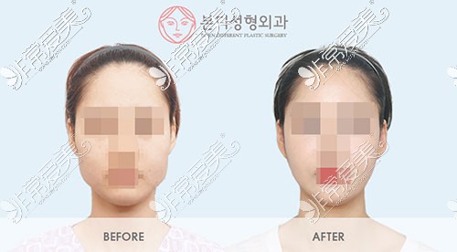韩国BornDi整形下颌角手术对比图