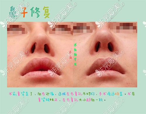 韩国美line整形歪鼻矫正图片