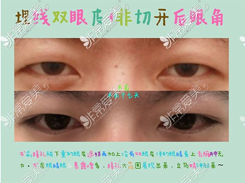 韩国美line男士双眼皮对比图