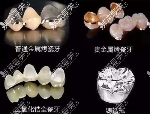 不同材质的牙冠