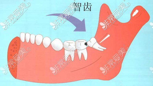 智齿长歪示意图