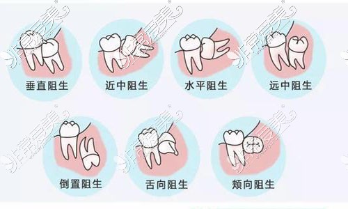 长春拔智齿多少钱一颗？分享长春拔智齿价格表~