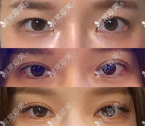 成都艺星医疗美容美容双眼皮
