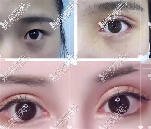 成都美辰星耀医美整形双眼皮