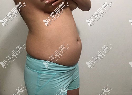 韩国歌柔飞腹部吸脂手术照片