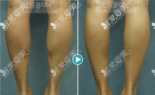 韩国BLS医院瘦小腿