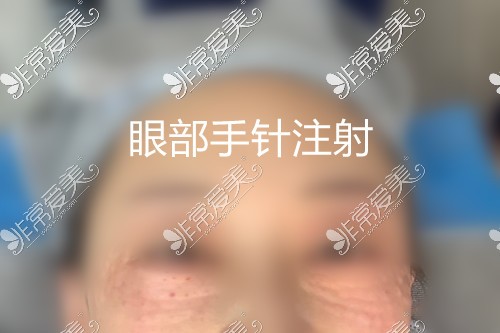 韩艺来美白除皱抗衰体验！眼部手针注射