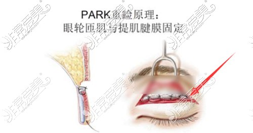 park法双眼皮照片图