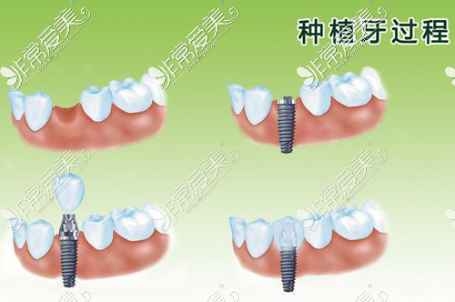 种植牙过程