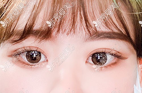 韩国yellow双眼皮整形图