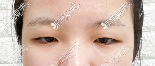韩国yellow双眼皮手术术前