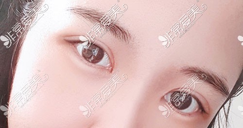 韩国yellow眼整形照片