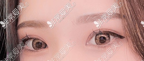 韩国yellow双眼皮手术图片