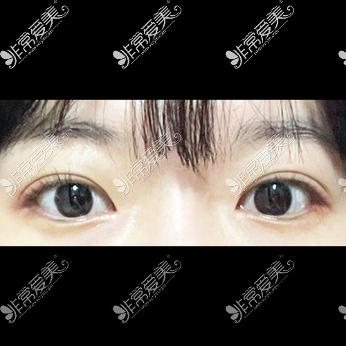 韩国icon整形医院双眼皮术后照片